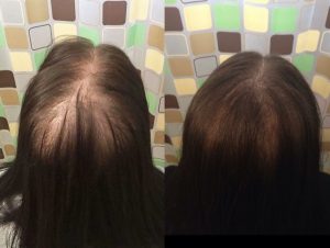 Photo shows the top and back of a woman’s head, demonstrating hair loss and increased visibility of her scalp.