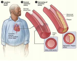 Diagram shows the location of the heart in the centre-left of the chest cavity. Next to this is a close-up cross-section of a healthy artery that is completely red, with a clean centre for blood to flow. Finally, an artery with a plaque buildup (in yellow) narrowing the blood flow.