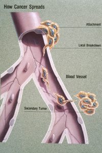 Diagram showing an image of a blood vessel through which cancer cells can travel and form new tumors in other parts of the body.