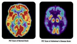 PET scan shows heavy activity in a healthy brain, and a lot of dark, inactive spots on the brain with Alzheimer's Disease