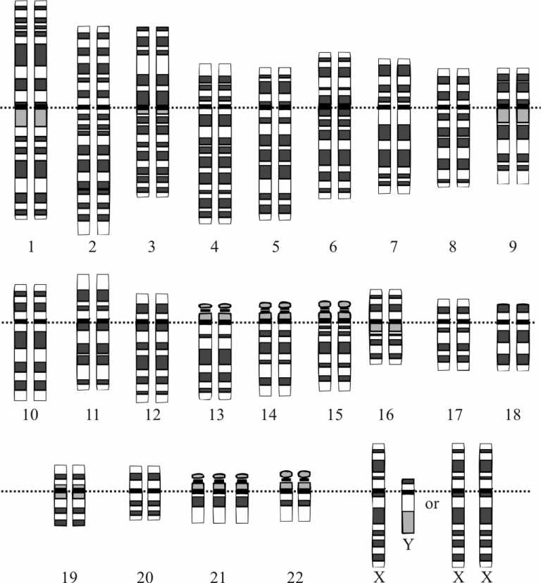 depiction of the chromosomes in trisomy 21
