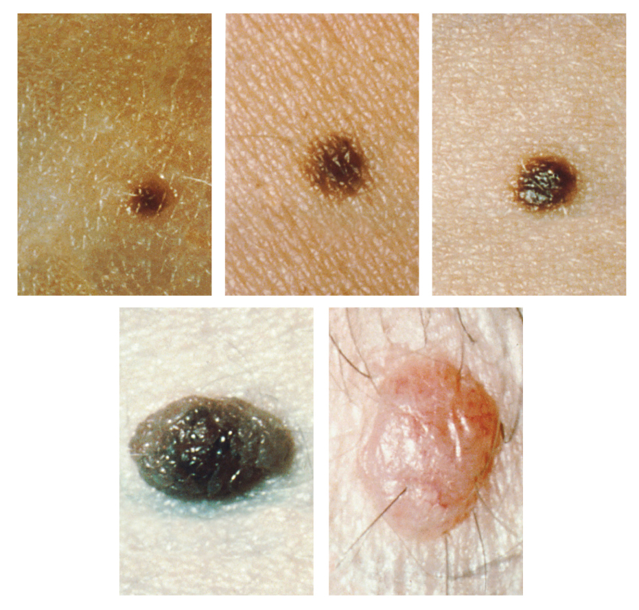 Five photos of moles. The three upper photos show moles that are small, flat, and dark brown. The bottom left photo shows a dark black mole that is raised above the skin. The bottom right photo shows a large, raised, reddish mole with protruding hairs.