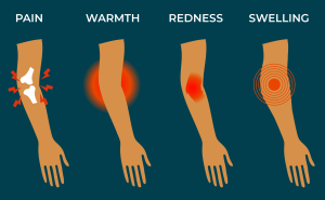 The 4 key signs of inflammation: pain, warmth, redness, and swelling.