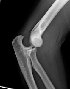 X-ray image of a dislocated elbow.