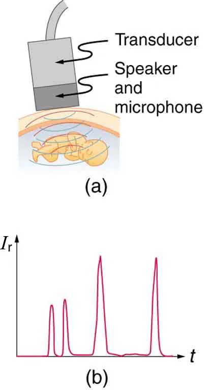 The first part of the diagram shows a rectangular shaped transducer with speaker and microphone sending spherical waves to produce echos from a fetus. The second part shows a graph of echo intensity versus time, with four sharp peaks.
