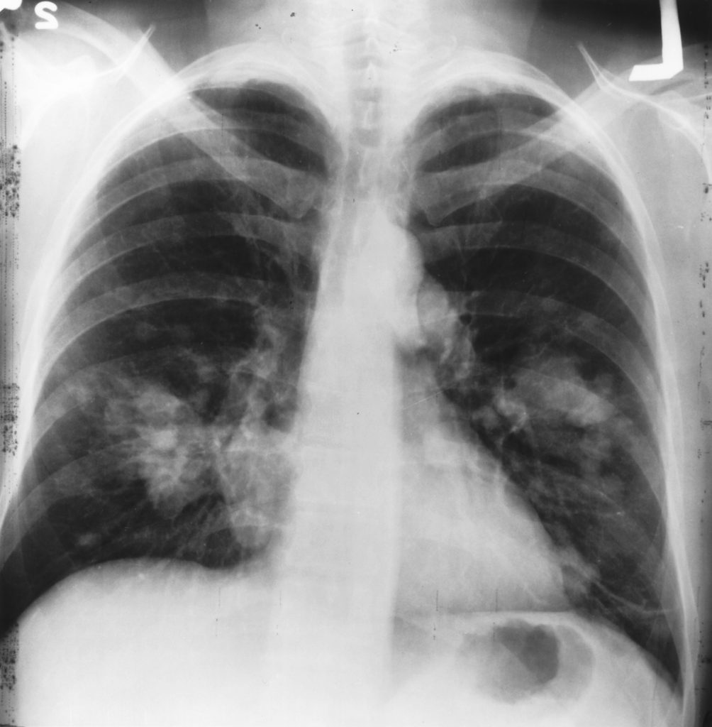 Chest X-ray (Cancer) of Lung Cancer