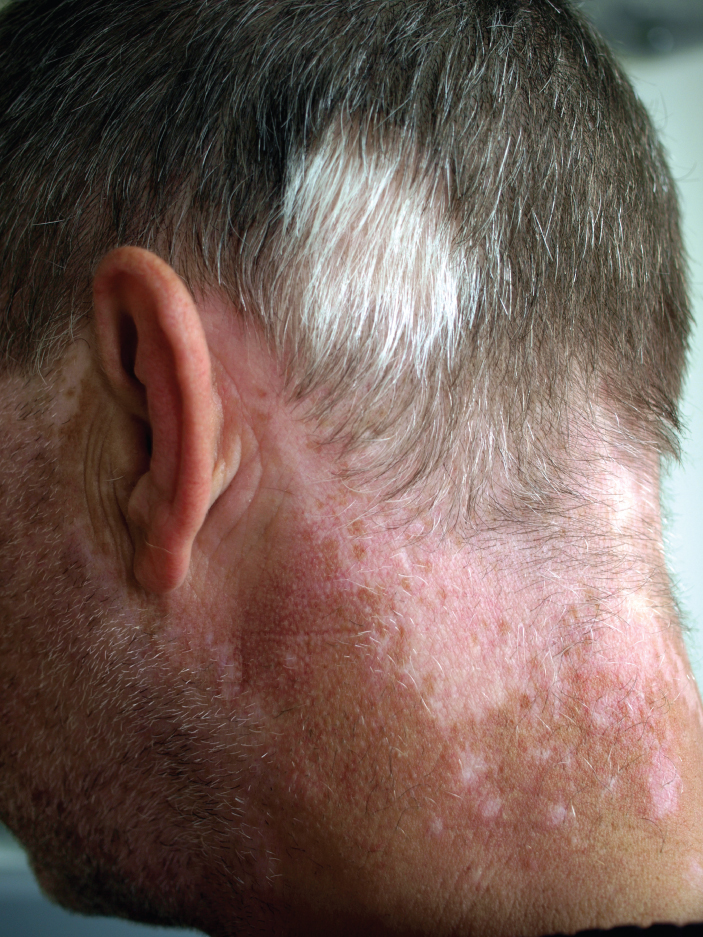 This photo shows the back of a man's neck. There is a large, discolored patch of skin at the base of his hairline. The discolored area extends over the ears onto the cheeks, toward the front of the face. The man's head and facial hair are mostly gray, but white patches of hair are seen above the discolored skin.