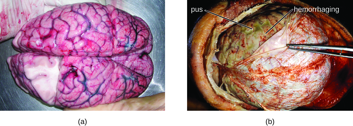 a) Photo of brain. B) Photo of think layer on top of brain being pulled back by forceps.