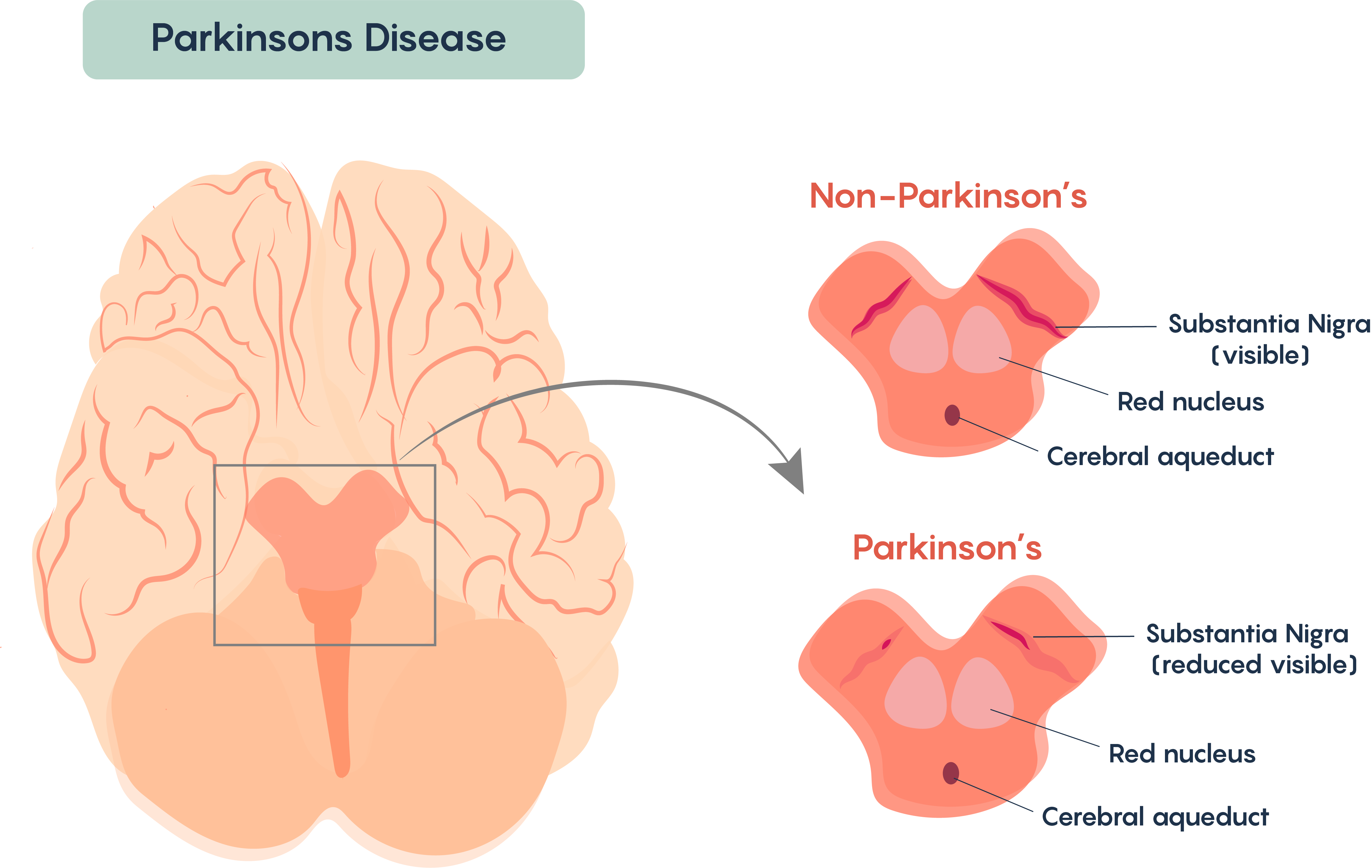 Loss of the pigmented dopaminergic neurons within the Substantia Nigra of individuals with Parkinson’s Disease.