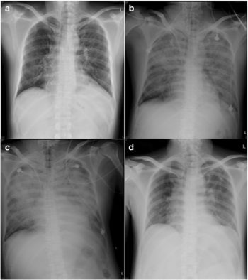 2.2 Overview of Acute Respiratory Distress Syndrome (ARDS) – Selected ...