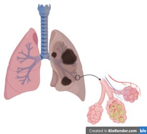 2.2 Overview of Acute Respiratory Distress Syndrome (ARDS) – Selected ...