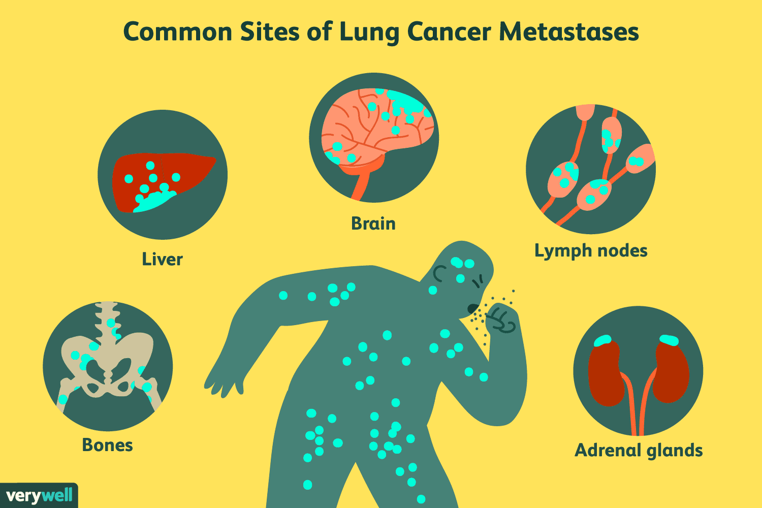 6.1 Overview of Non-Small Cell Lung Cancer (NSCLC) – Selected Topics in ...